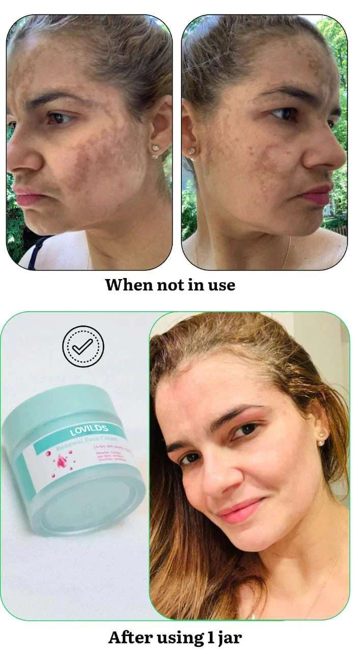 Flash Sale Ending Soonđ„LOVILDSâą Renewal Skin Cream | Spot Removal & Skin Renewal for Dark Spots, Age Spots, and Sun Spots* Daily Firming for All Skin Types