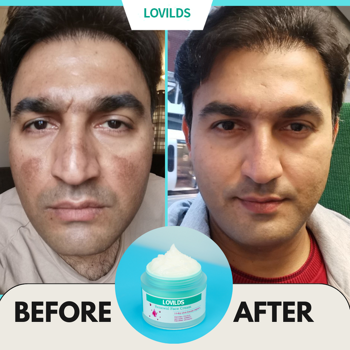 Flash Sale Ending Soonđ„LOVILDSâą Renewal Skin Cream | Spot Removal & Skin Renewal for Dark Spots, Age Spots, and Sun Spots* Daily Firming for All Skin Types