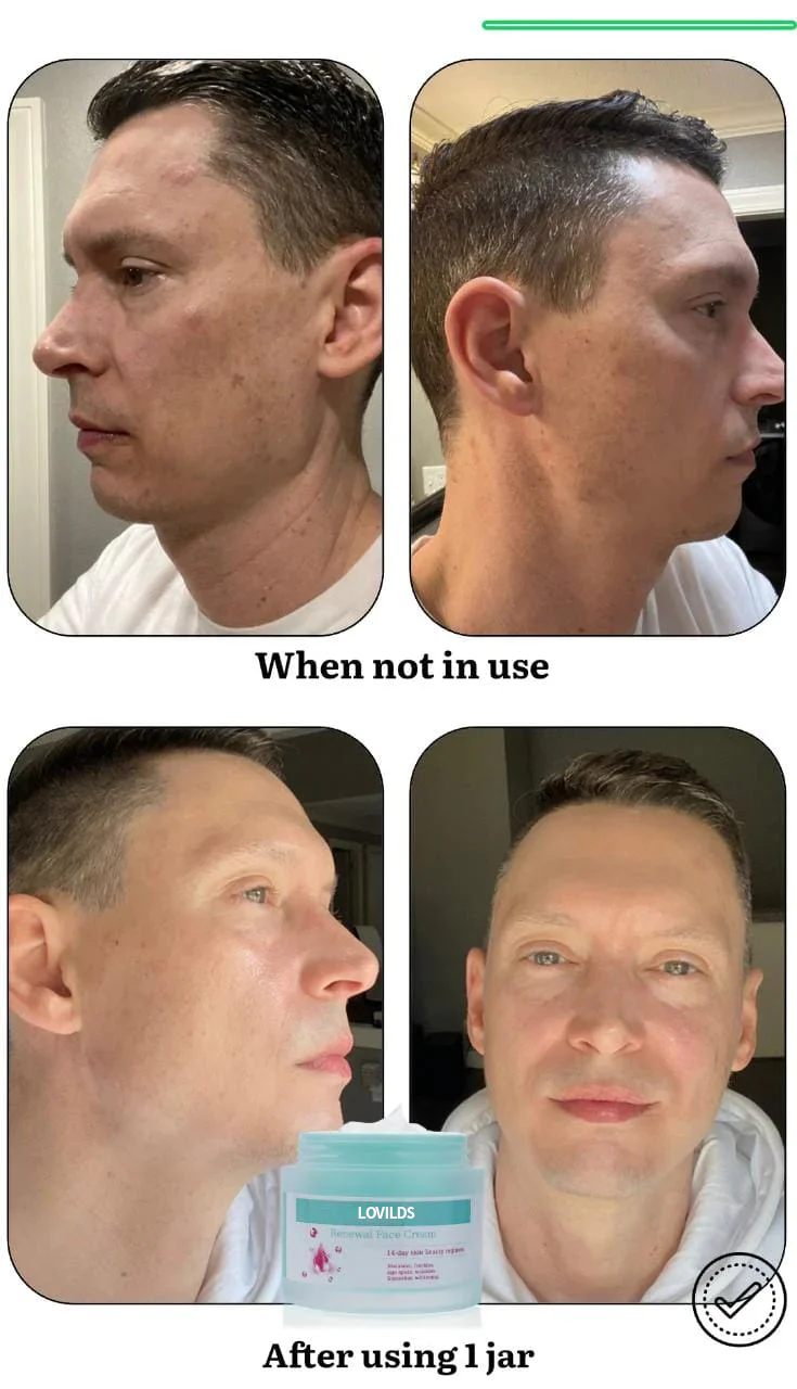 Flash Sale Ending Soon💥LOVILDS™ Renewal Skin Cream | Spot Removal & Skin Renewal for Dark Spots, Age Spots, and Sun Spots* Daily Firming for All Skin Types
