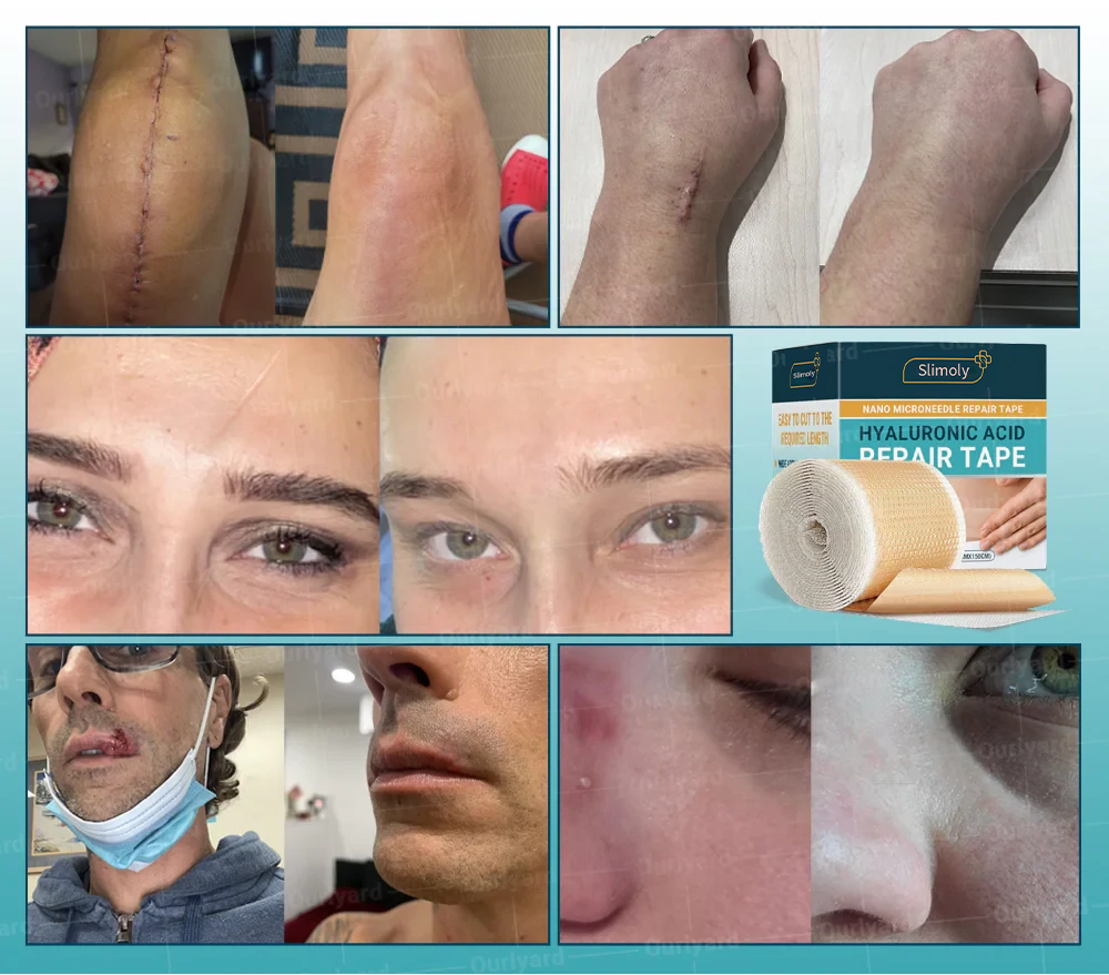 Official Store |Slimoly™ Hyaluronic Acid Nano Microneedle Repair Tape🗽🎉(Treatment of old and new scars, reduction of surgical scars, stretch marks, keloids, acne, burns, warts, dermatomes and varicose veins)