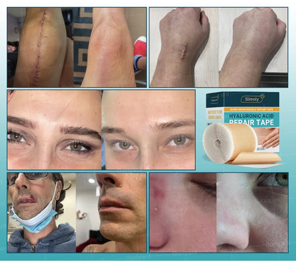Official Store |Slimoly™ Hyaluronic Acid Nano Microneedle Repair Tape🗽🎉(Treatment of old and new scars, reduction of surgical scars, stretch marks, keloids, acne, burns, warts, dermatomes and varicose veins)