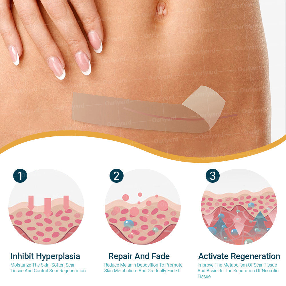 Official Store |Slimoly™ Hyaluronic Acid Nano Microneedle Repair Tape🗽🎉(Treatment of old and new scars, reduction of surgical scars, stretch marks, keloids, acne, burns, warts, dermatomes and varicose veins)
